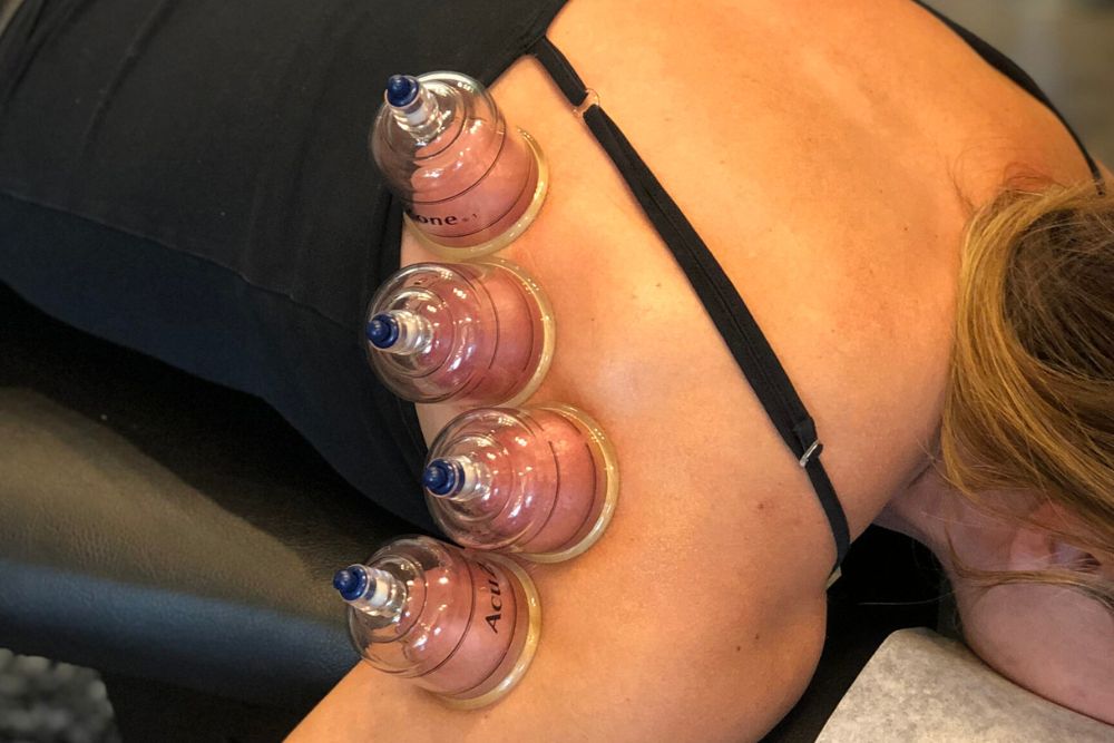 cupping treatment on shoulder