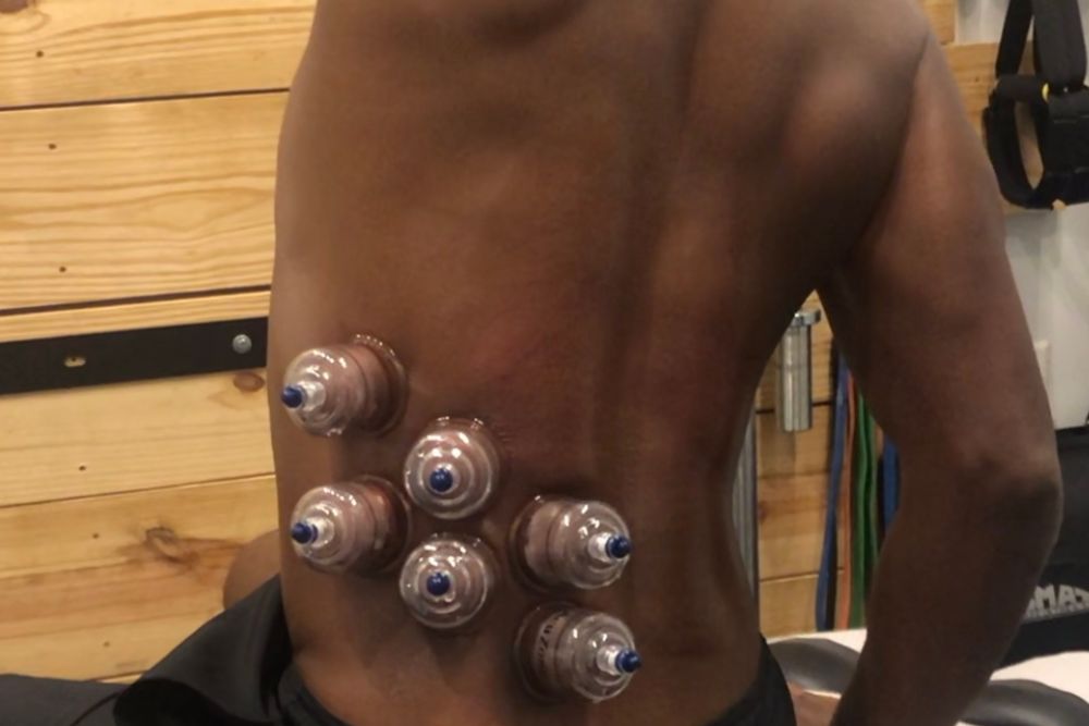 cupping treatment on lower back