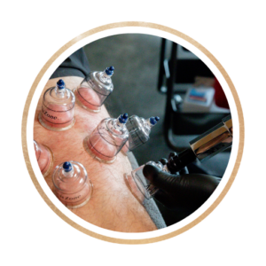 cupping treatment being performed