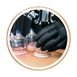 placing a cup for cupping treatment