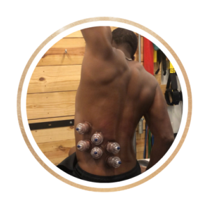 cupping treatment on back